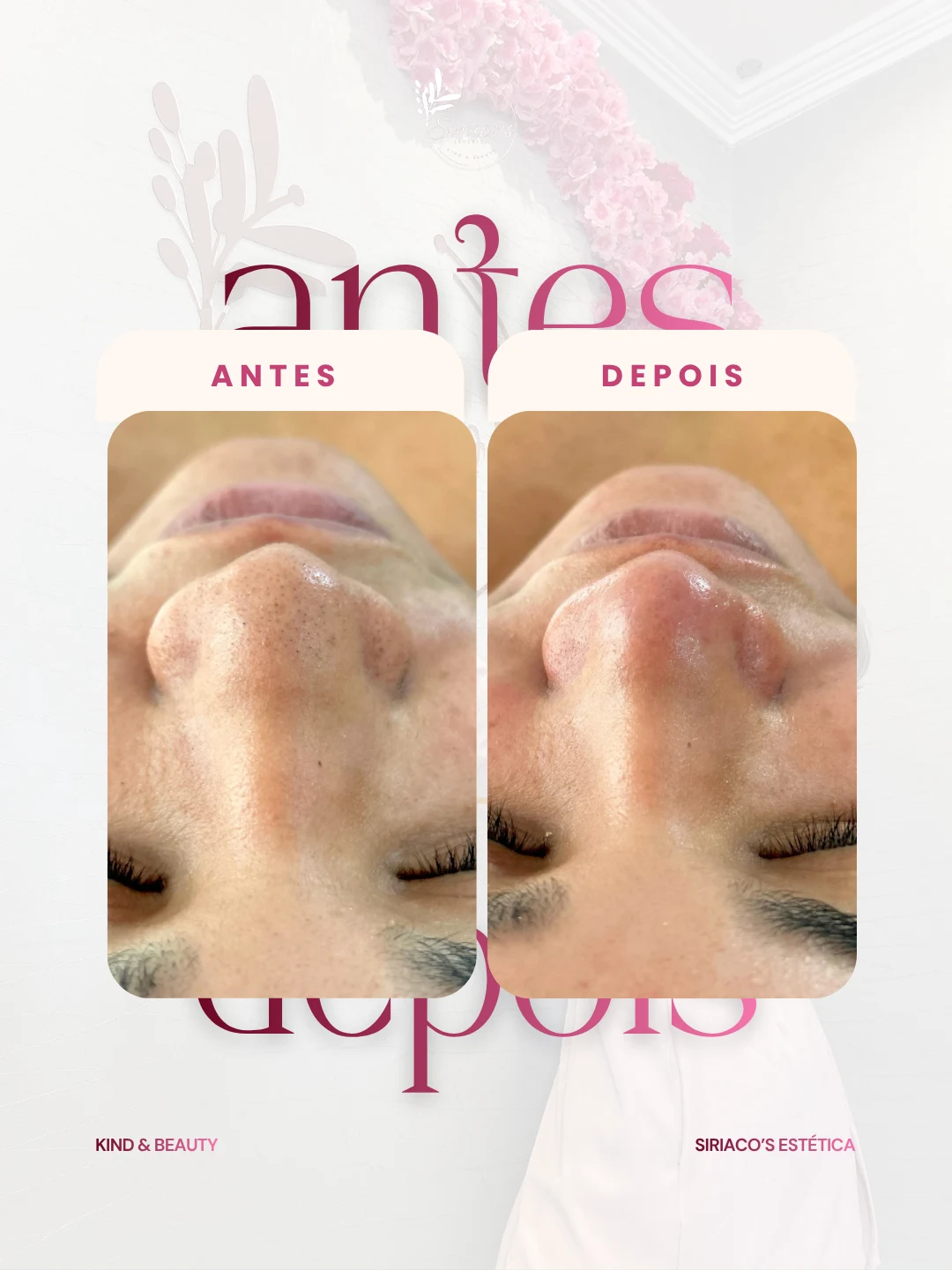 Antes e depois - Limpeza de Pele