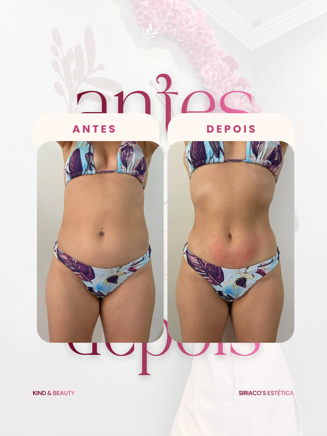 Antes e depois - Modelagem Corporal
