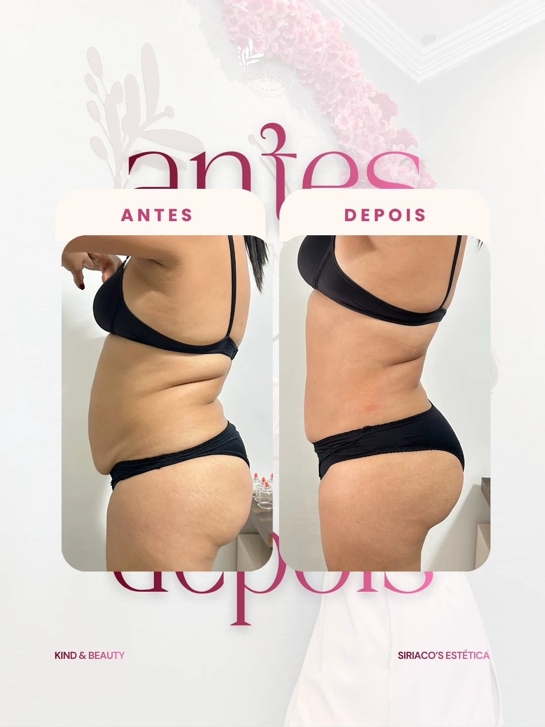 Antes e depois - Modelagem Corporal