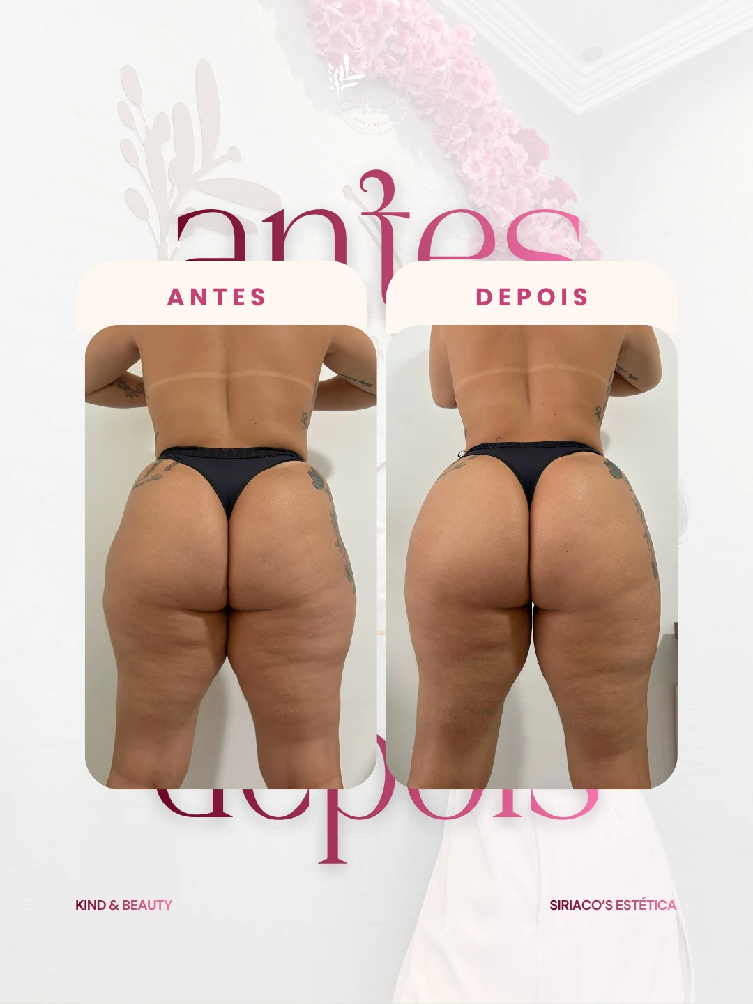 Antes e depois - Redução de Celulite