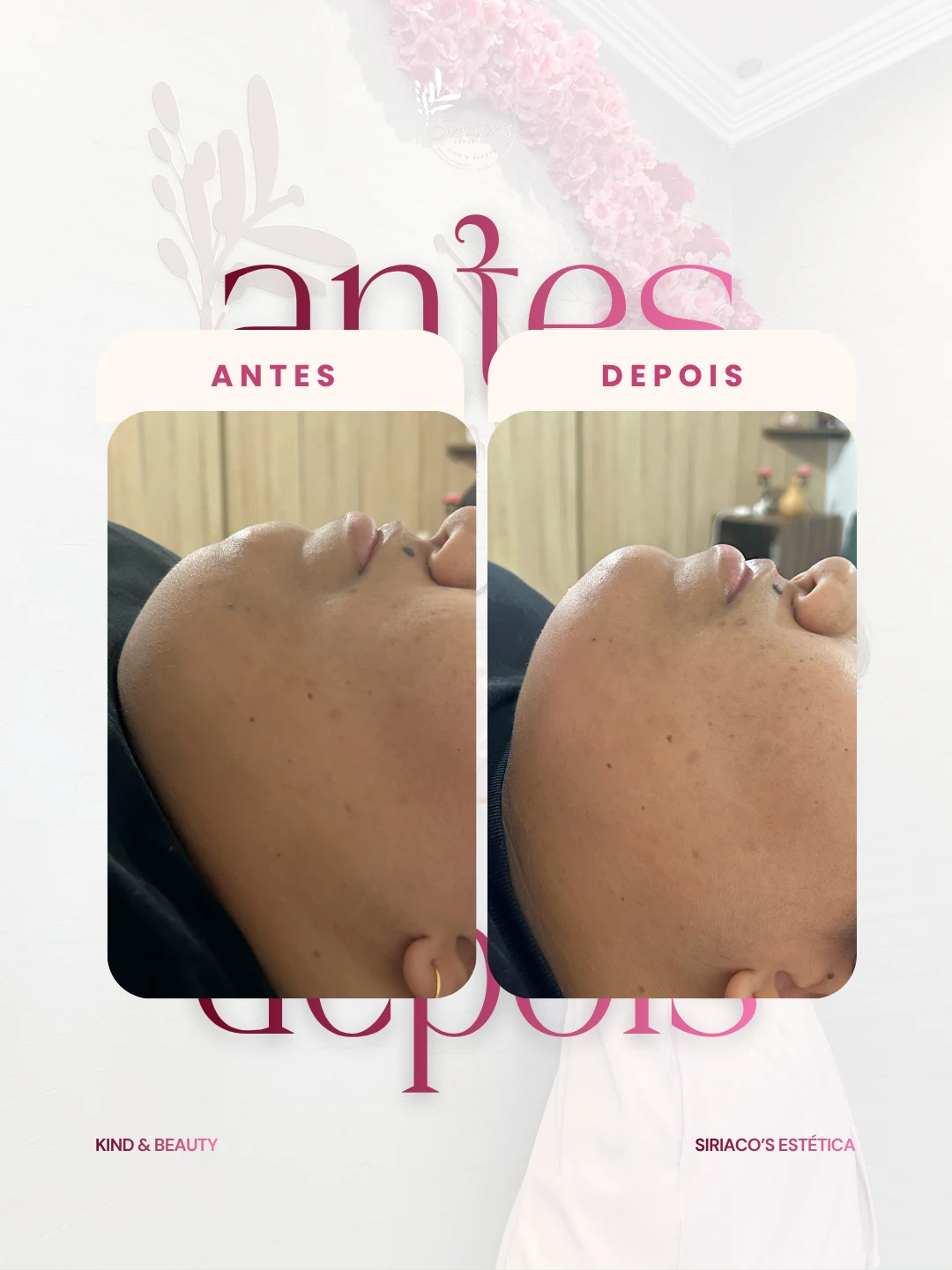 Antes e depois - Redução de Papada