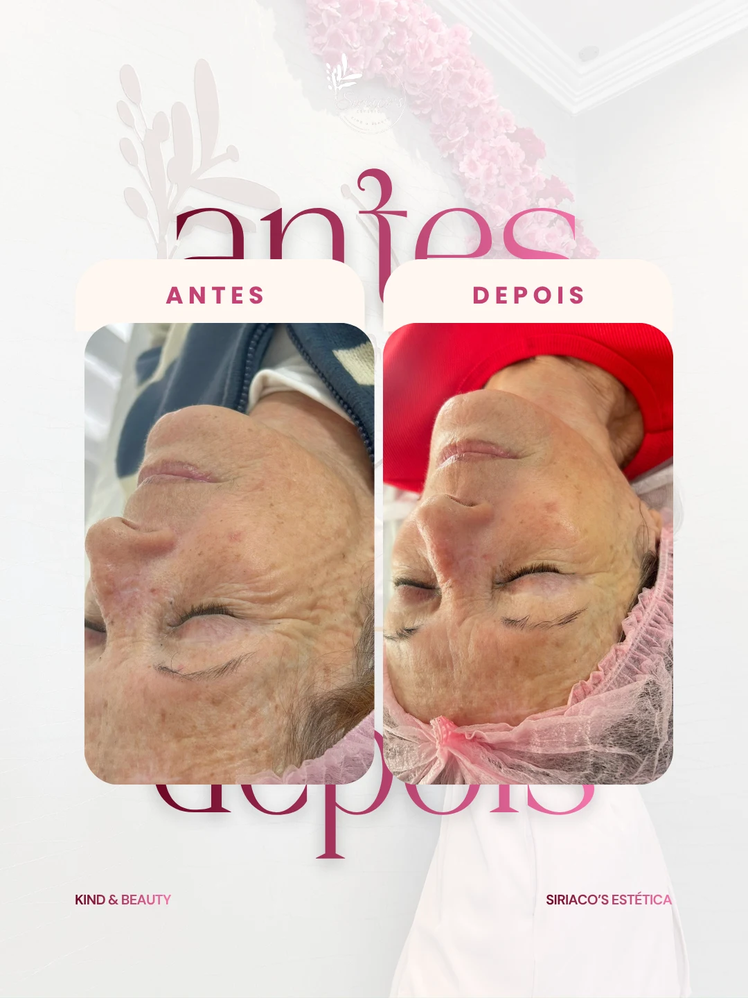 Antes e depois - Rejuvenescimento Facial